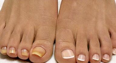 Metodi di trattamento dei funghi della flotta