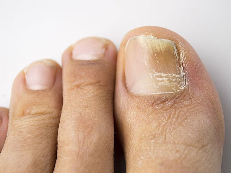 La fase iniziale del fungo