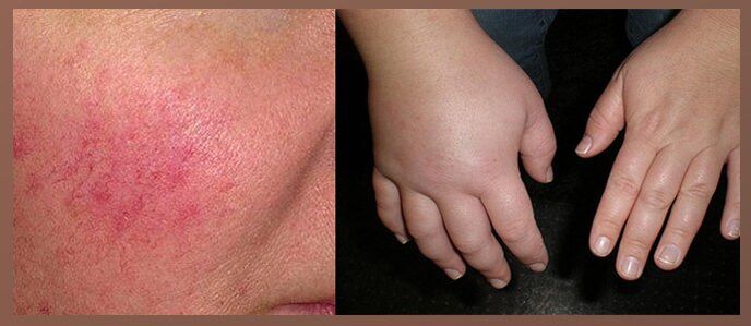 Effetti collaterali delle gocce