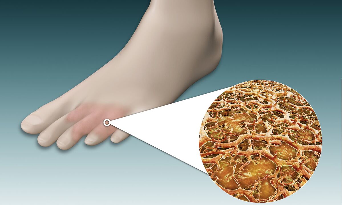 Spore fungine sui piedi